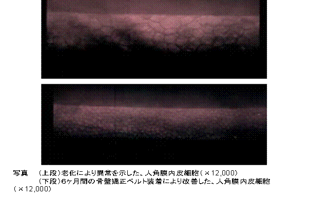 骨盤矯正ベルト装着前後の角膜内皮細胞の比較